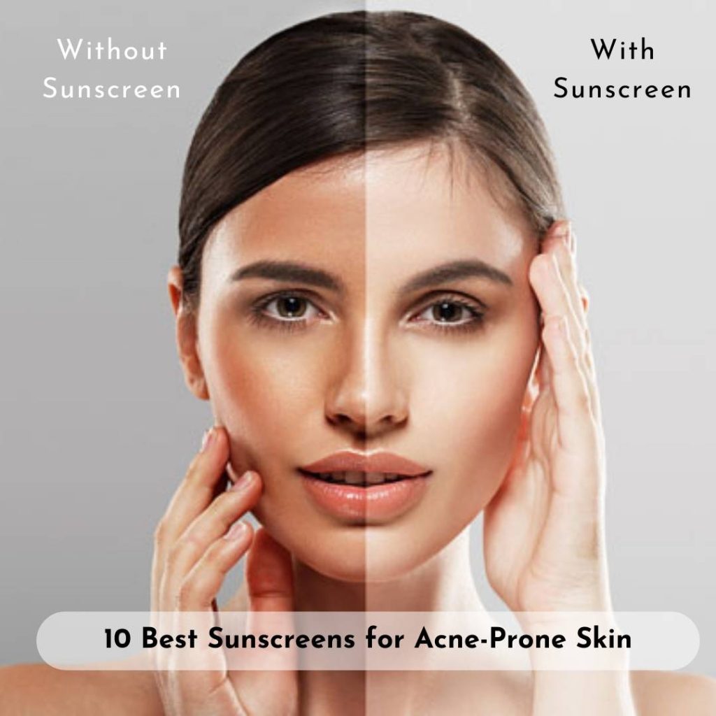 10 Best Sunscreens for AcneProne Skin by Expert Suggestion