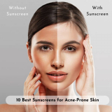 10 Best Sunscreens for Acne-Prone Skin